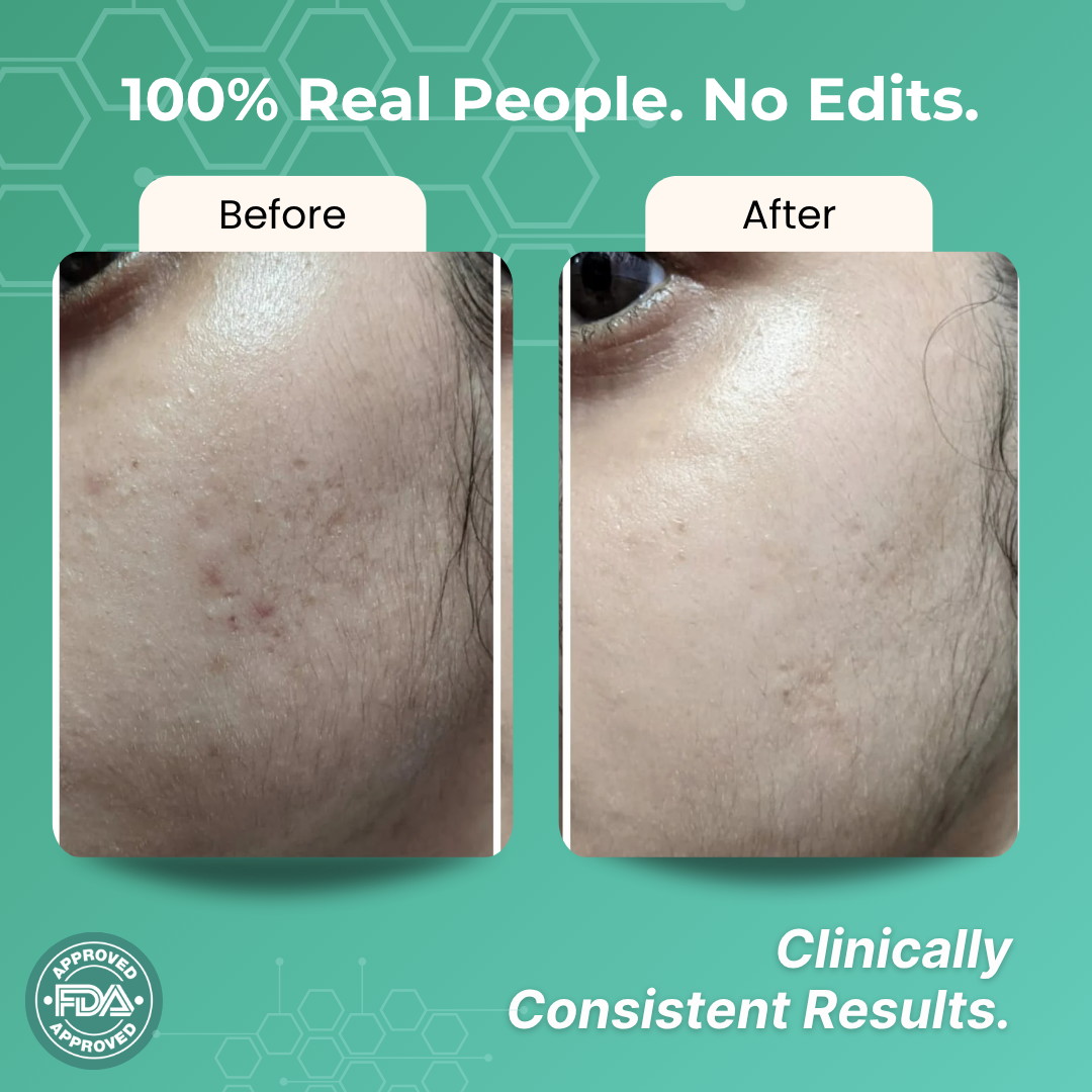 Skincare products showcased for daily acne protection