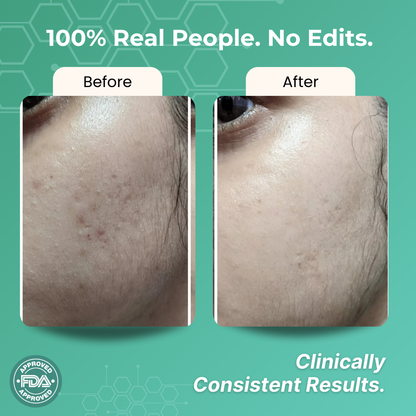 Skincare products showcased for daily acne protection