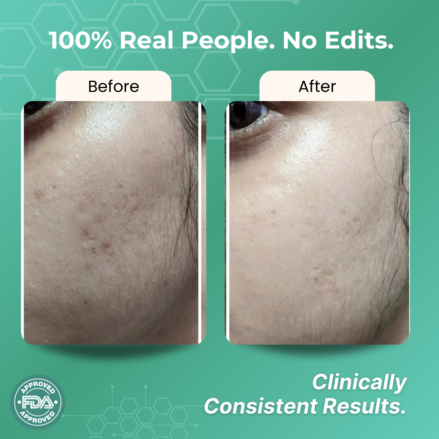 Acne Face Serum with 5% Niacinamide | Niacinamide & Salicylic acid Akne Facewash