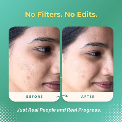 Akne Solution - Niacinamide & Salicylic acid Akne Facewash 100ml