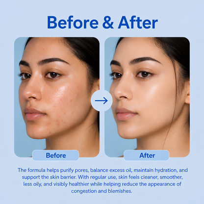 Oil + Acne Face wash 100ml