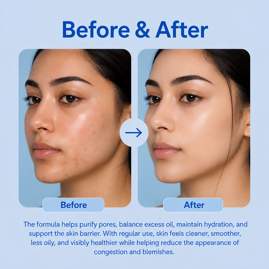 Oil + Acne Face wash 100ml
