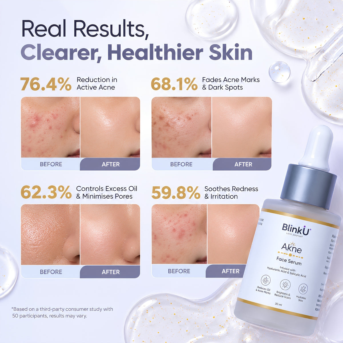 Akne Face Serum with 5% Niacinamide & Salicylic Acid – 30ml
