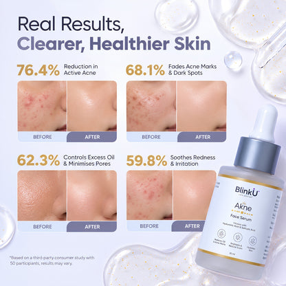 Akne Face Serum with 5% Niacinamide & Salicylic Acid – 30ml