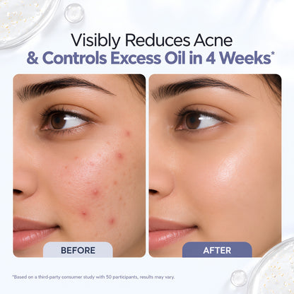 Akne Face Serum with 5% Niacinamide & Salicylic Acid – 30ml